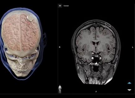 Primer paciente del Neuralink logra controlar mouse con la mente